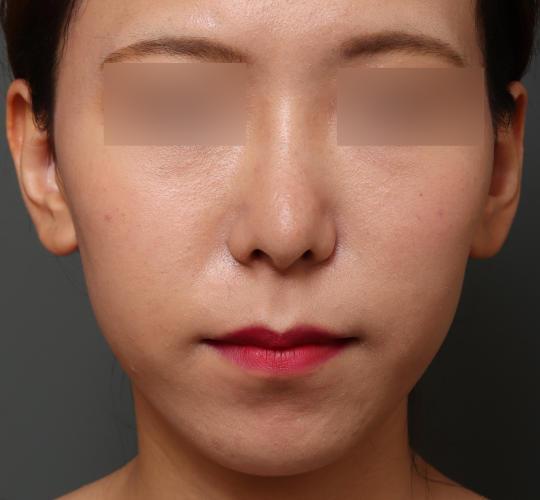 20代女性の人中短縮（リップリフト） Before 症例写真