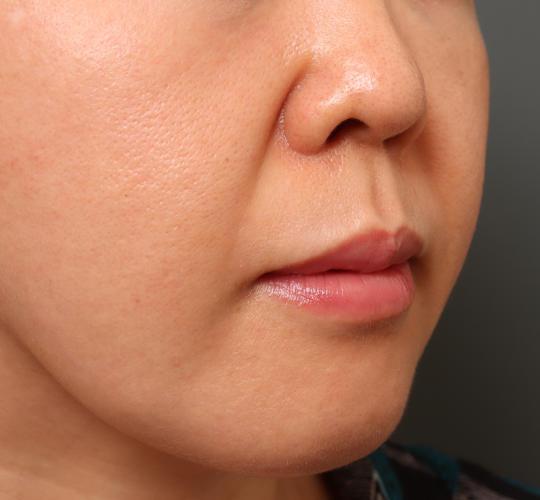 40代女性の鼻翼縮小（小鼻縮小） Before 症例写真