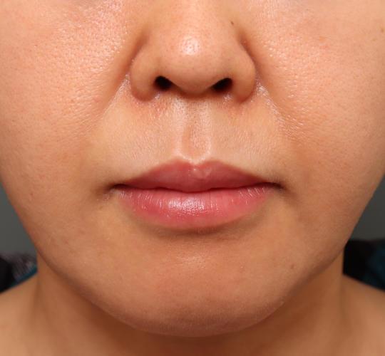 40代女性の鼻翼縮小（小鼻縮小） Before 症例写真