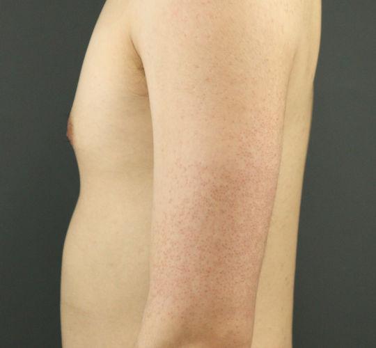 20代男性の毛孔性苔癬フラクセル After 症例写真