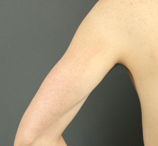 20代男性の毛孔性苔癬フラクセル After 症例写真