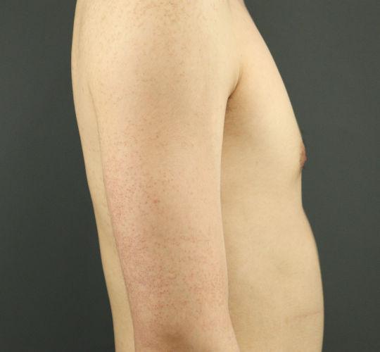 20代男性の毛孔性苔癬フラクセル After 症例写真