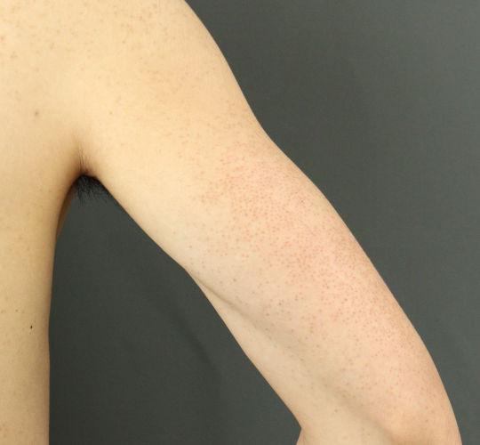 20代男性の毛孔性苔癬フラクセル After 症例写真