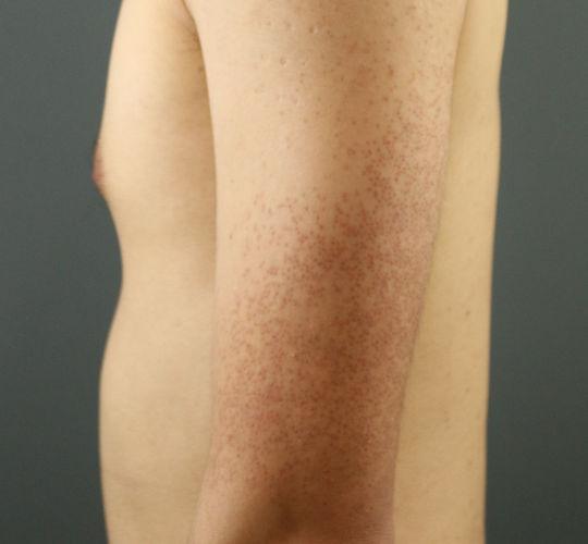 20代男性の毛孔性苔癬フラクセル Before 症例写真