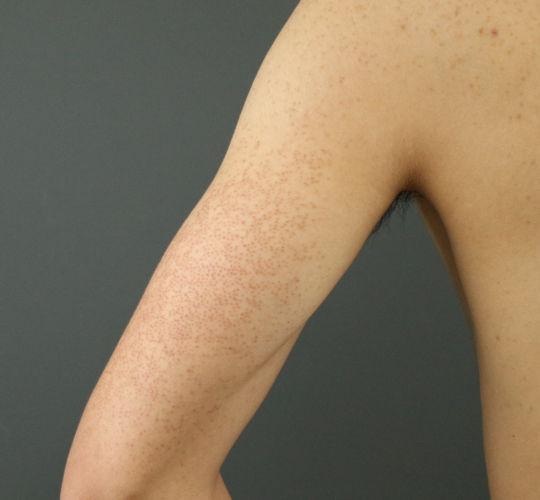 20代男性の毛孔性苔癬フラクセル Before 症例写真