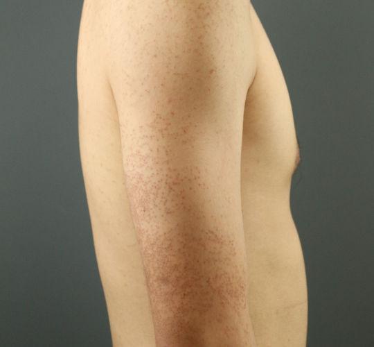 20代男性の毛孔性苔癬フラクセル Before 症例写真