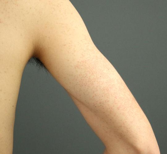 20代男性の毛孔性苔癬フラクセル Before 症例写真