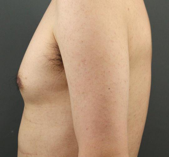 30代男性の毛孔性苔癬・角化症 After 症例写真