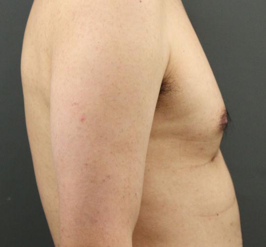 30代男性のFotonaフラクショナルレーザー(毛孔性苔癬) After 症例写真