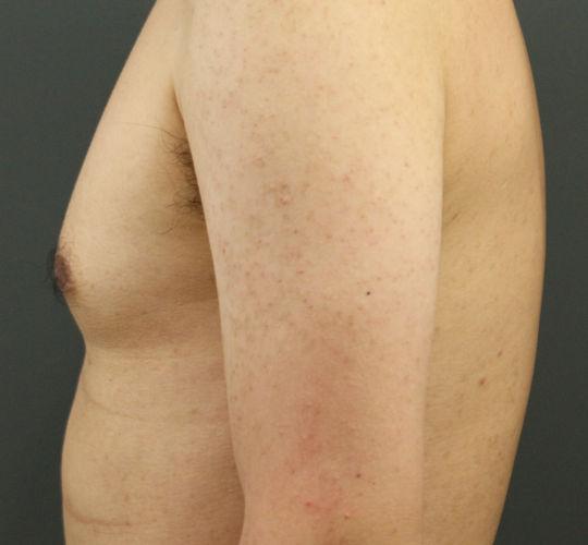 30代男性の毛孔性苔癬・角化症 Before 症例写真