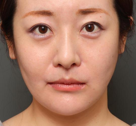 30代女性のM字リップ形成 After 症例写真