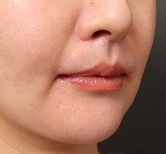 30代女性のM字リップ形成 After 症例写真