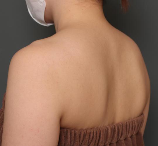 20代女性のボトックス(美肩・肩こり解消) After 症例写真
