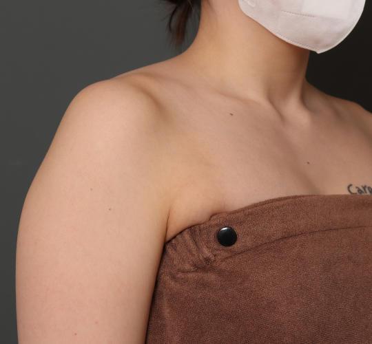 20代女性のボトックス(美肩・肩こり解消) After 症例写真