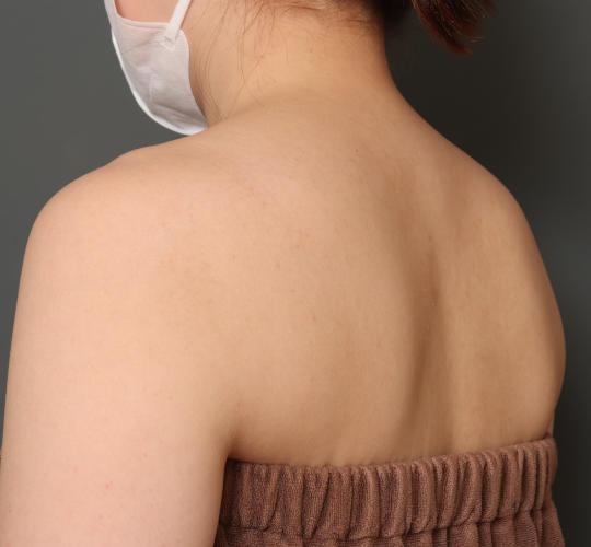 20代女性のボトックス(美肩・肩こり解消) Before 症例写真
