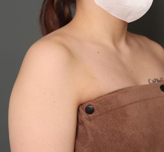 20代女性のボトックス(美肩・肩こり解消) Before 症例写真