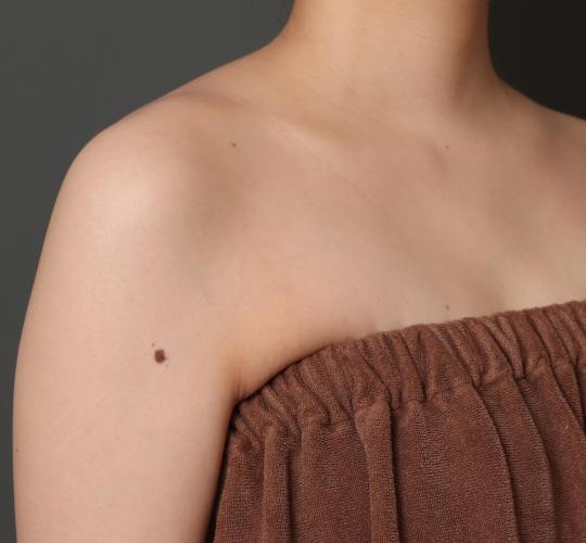 20代女性のボトックス(美肩・肩こり解消) After 症例写真