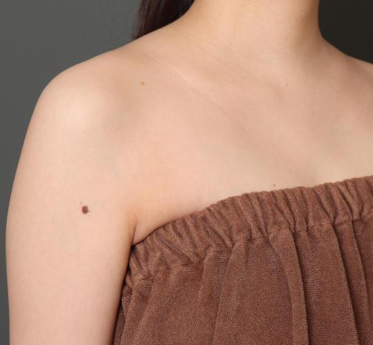 20代女性のボトックス(美肩・肩こり解消) Before 症例写真
