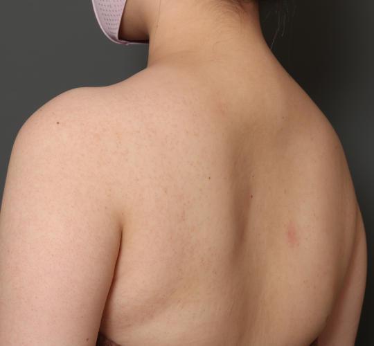 20代女性のボトックス(美肩・肩こり解消) After 症例写真