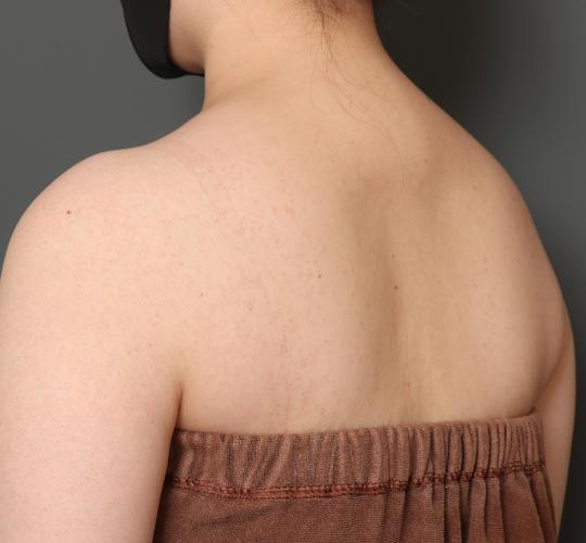 20代女性のボトックス(美肩・肩こり解消) Before 症例写真