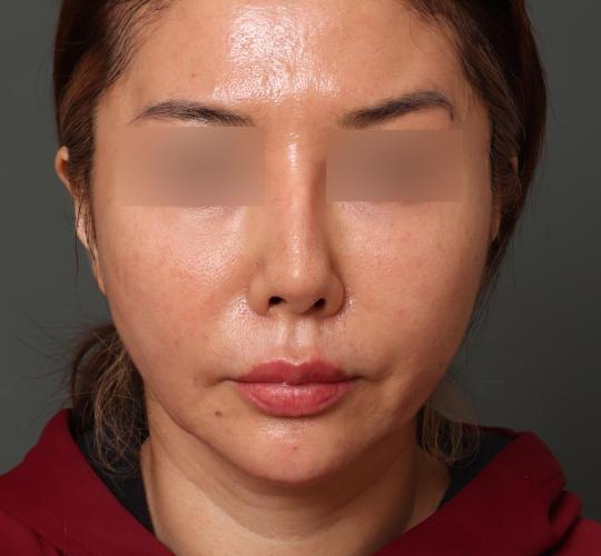 40代女性のVOVリフトプレミアム After 症例写真