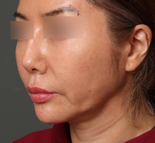 40代女性の顔の脂肪吸引  After 症例写真