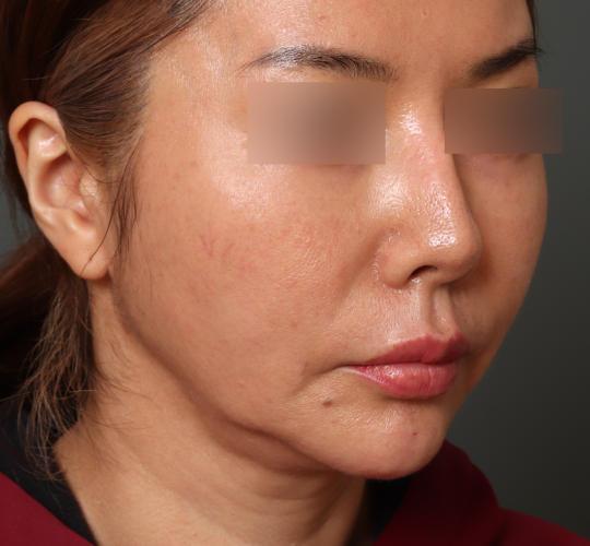 40代女性の顔の脂肪吸引  After 症例写真