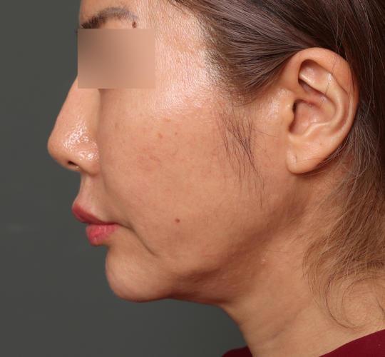 40代女性の顔の脂肪吸引  After 症例写真