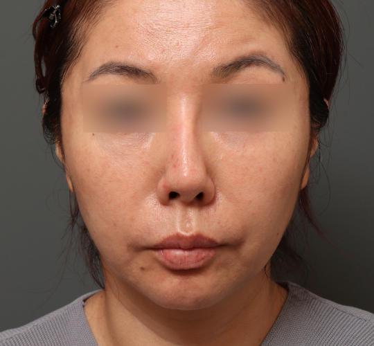 40代女性のVOVリフトプレミアム Before 症例写真