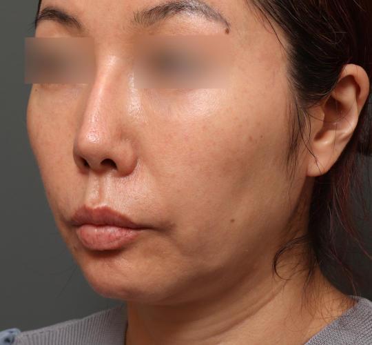 40代女性の顔の脂肪吸引  Before 症例写真