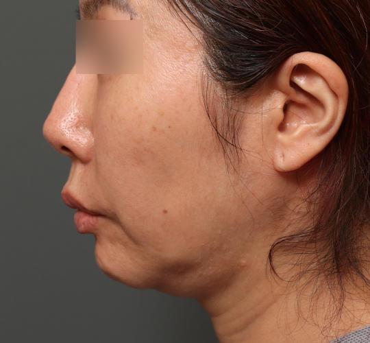 40代女性の顔の脂肪吸引  Before 症例写真
