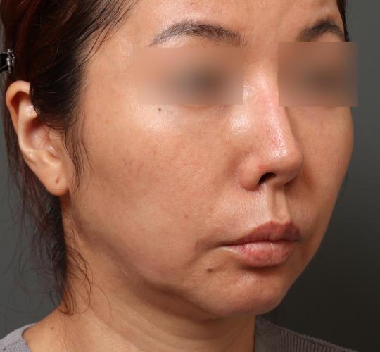 40代女性の顔の脂肪吸引  Before 症例写真