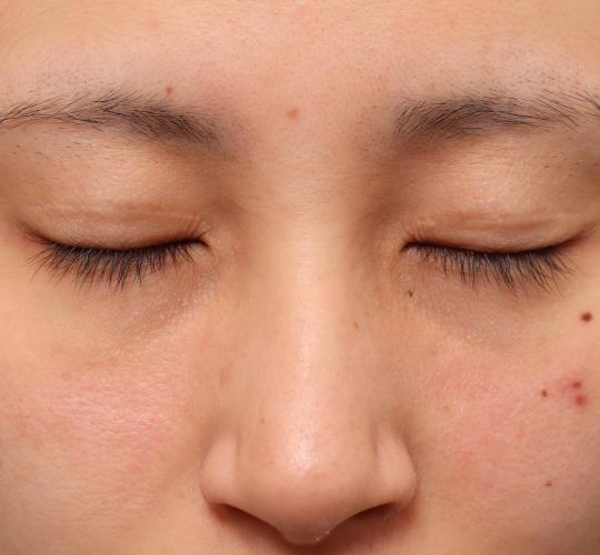 20代女性の目つき矯正 After 症例写真