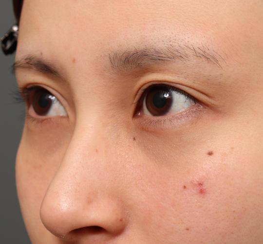 20代女性の目つき矯正 After 症例写真