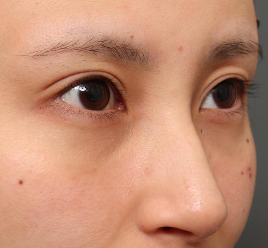 20代女性の目つき矯正 After 症例写真