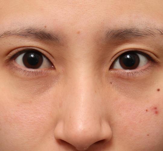 20代女性の二重整形・目元の整形 After 症例写真