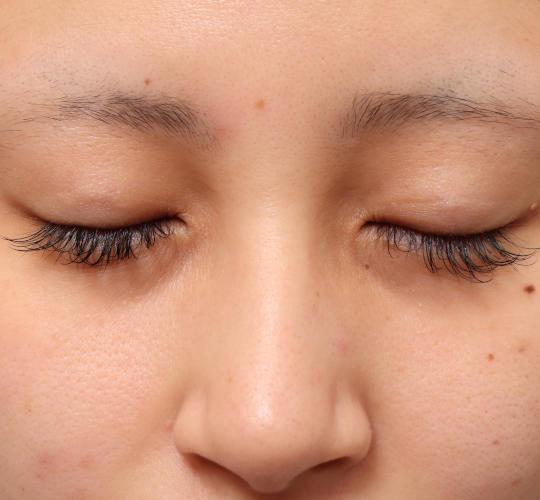 20代女性の目つき矯正 Before 症例写真