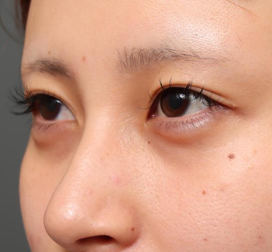 20代女性の目つき矯正 Before 症例写真