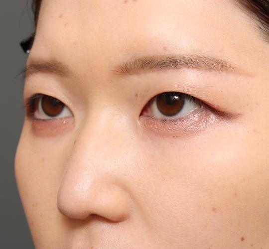 20代女性の眉下切開法 After 症例写真