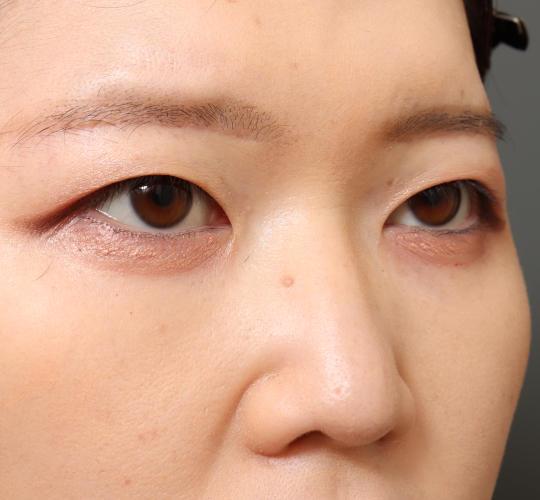20代女性の眉下切開法 After 症例写真