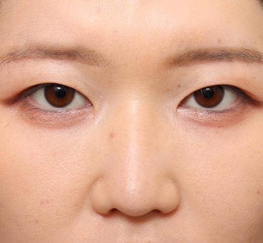 20代女性の眉下切開法 After 症例写真