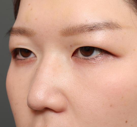 20代女性の眉下切開法 Before 症例写真