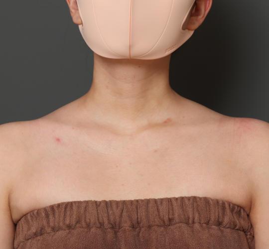 20代女性のボトックス(美肩・肩こり解消) After 症例写真
