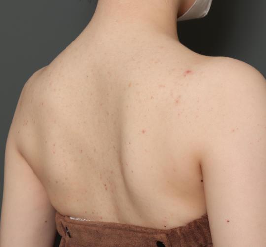 20代女性のボトックス(美肩・肩こり解消) After 症例写真