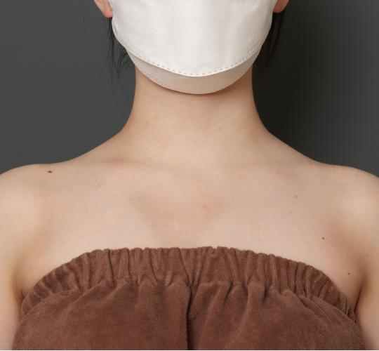 20代女性のボトックス(美肩・肩こり解消) After 症例写真