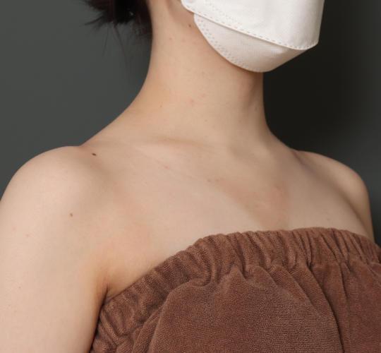 20代女性のボトックス(美肩・肩こり解消) After 症例写真
