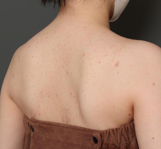 20代女性のボトックス(美肩・肩こり解消) Before 症例写真