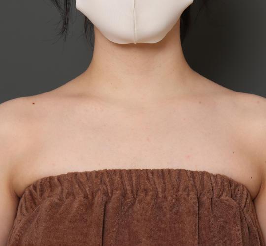 20代女性のボトックス(美肩・肩こり解消) Before 症例写真