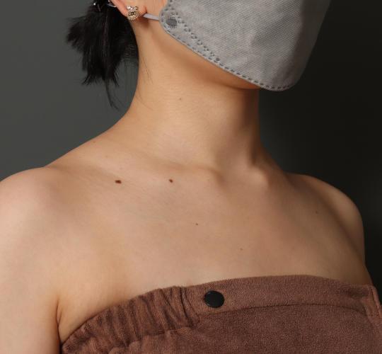 20代女性のボトックス(美肩・肩こり解消) After 症例写真