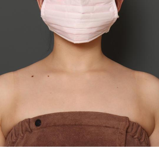 20代女性のボトックス(美肩・肩こり解消) Before 症例写真